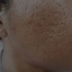 Large Pores/ Scars Solution